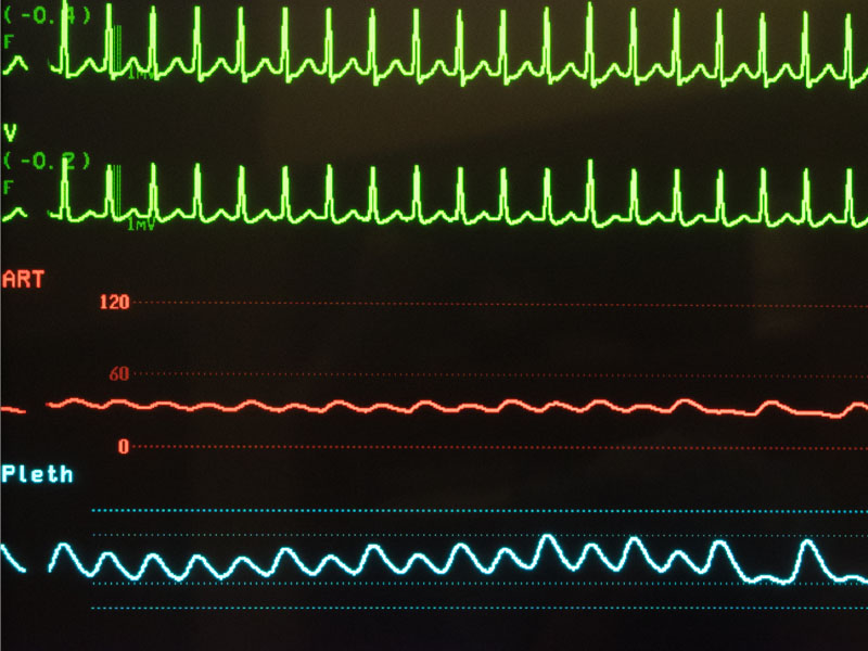 czarne ekg tachykardia