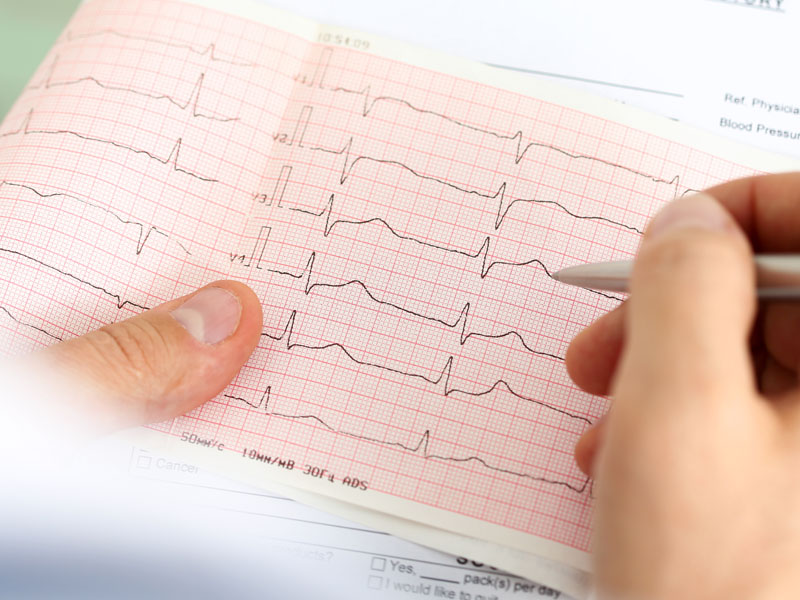 Hiperkaliemia w EKG