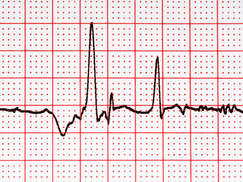 ekg migotanie przedsionkow