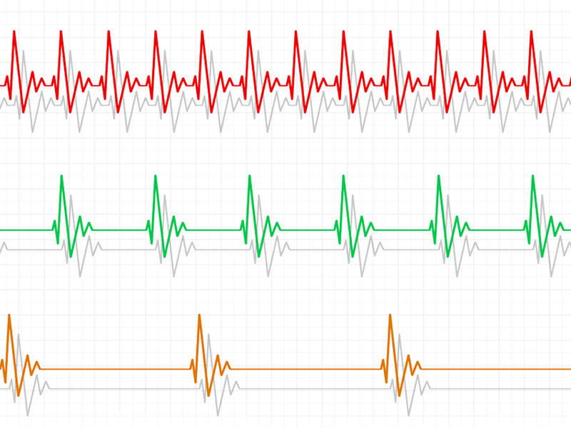 Tachykardia i bradykardia w EKG